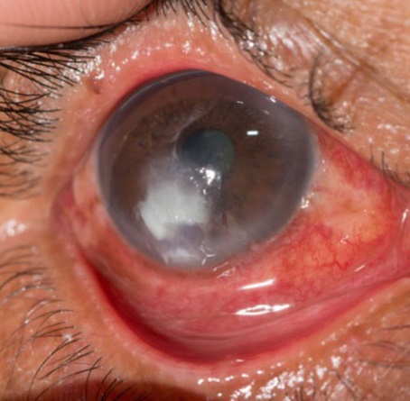 Loét giác mạc do vi khuẩn – Nguyên nhân, triệu chứng và cách xử  trí